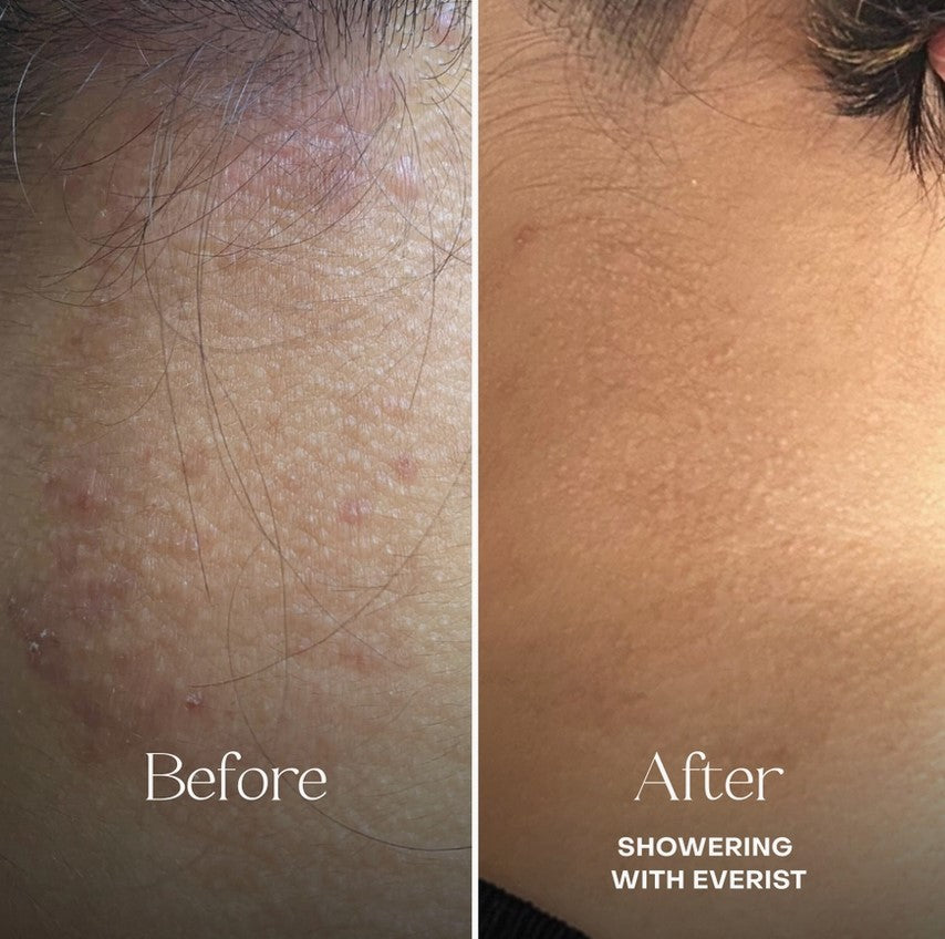 Before and after sensitive scalp results using Everist Fragrance Free Conditioner – reduced redness and irritation