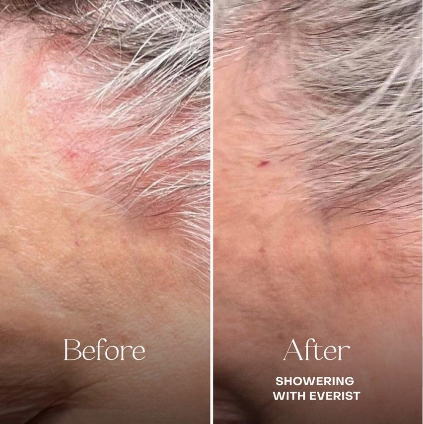 Everist Fragrance-Free Shampoo Concentrate results – improved scalp health and hydration for sensitive scalps