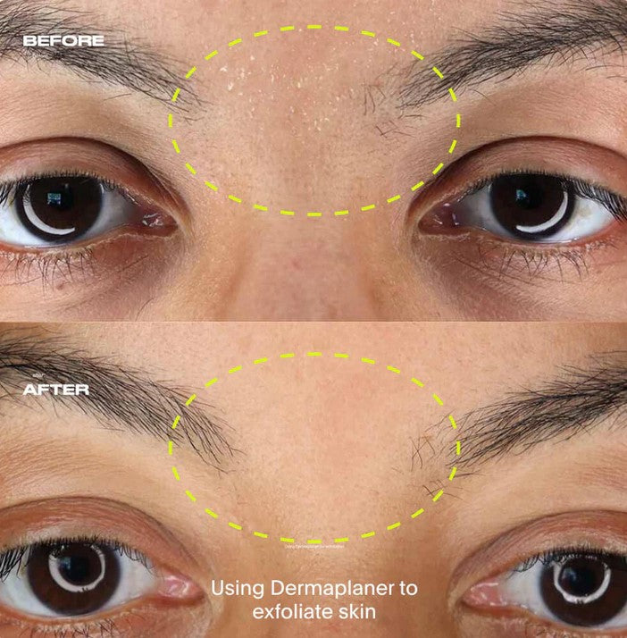 Leaf Dermaplaner forehead exfoliation – visible improvement in skin texture and smoothness